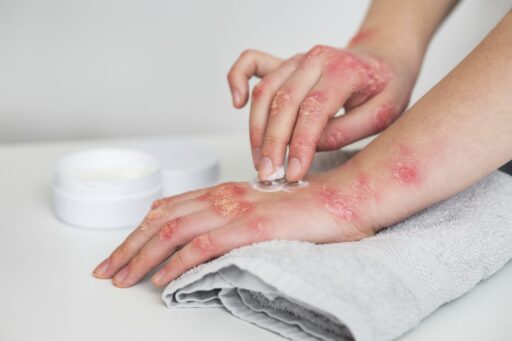 como aliviar eczemas